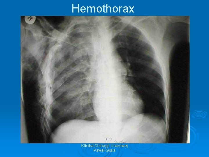 Hemothorax Klinika Chirurgii Urazowej Paweł Grala 