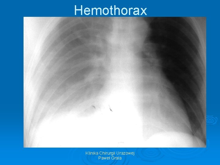 Hemothorax Klinika Chirurgii Urazowej Paweł Grala 