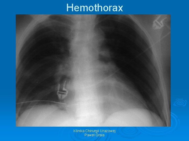 Hemothorax Klinika Chirurgii Urazowej Paweł Grala 