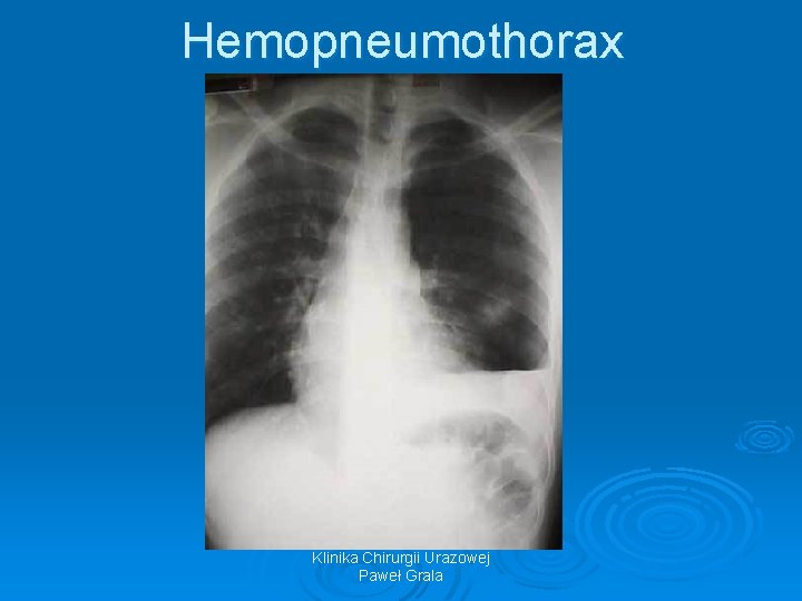 Hemopneumothorax Klinika Chirurgii Urazowej Paweł Grala 