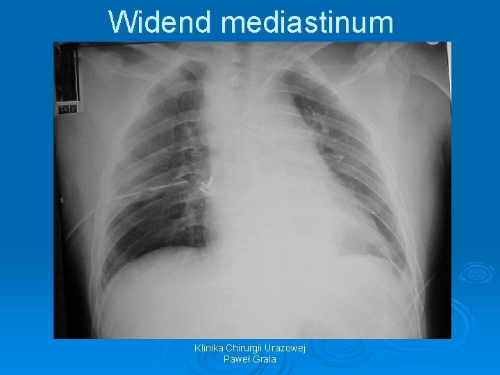 Widend mediastinum Klinika Chirurgii Urazowej Paweł Grala 