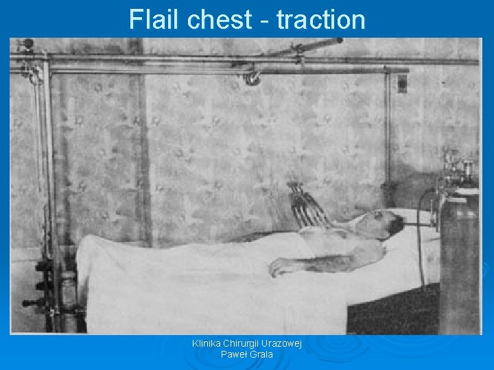 Flail chest - traction Klinika Chirurgii Urazowej Paweł Grala 