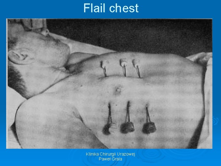 Flail chest Klinika Chirurgii Urazowej Paweł Grala 