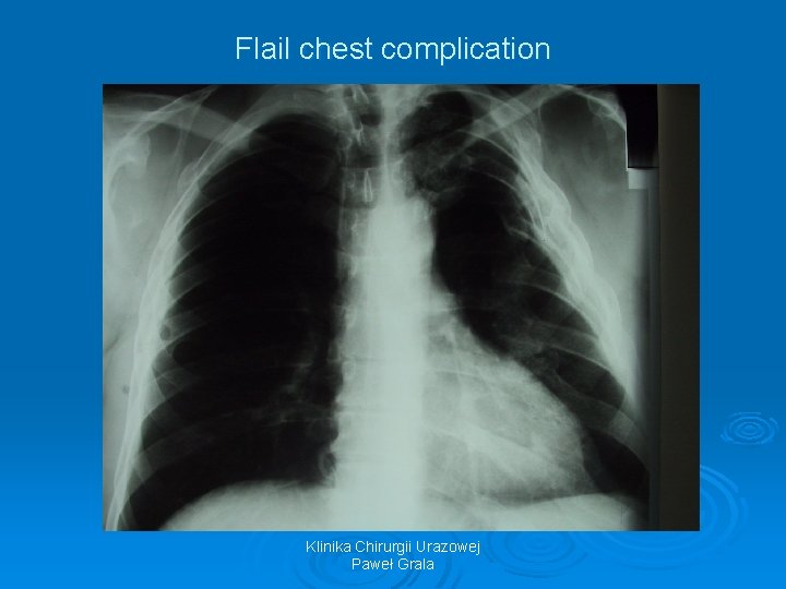 Flail chest complication Klinika Chirurgii Urazowej Paweł Grala 
