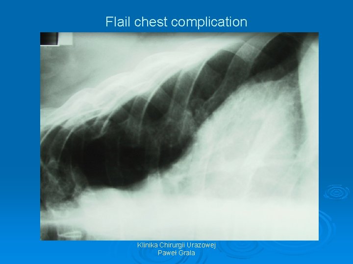 Flail chest complication Klinika Chirurgii Urazowej Paweł Grala 
