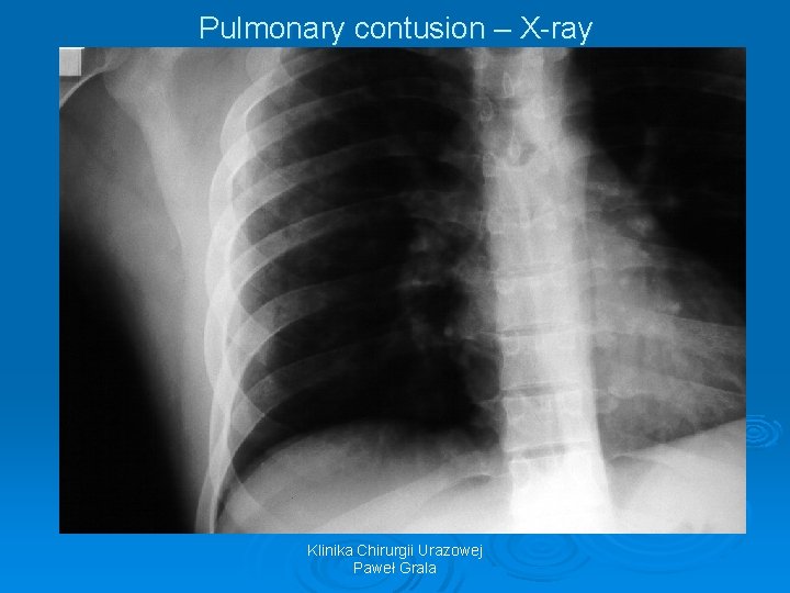 Pulmonary contusion – X-ray Klinika Chirurgii Urazowej Paweł Grala 