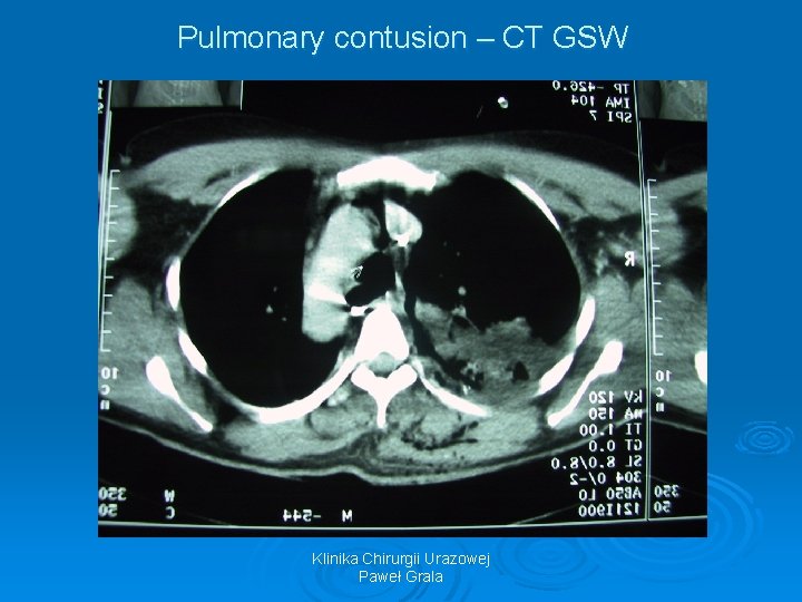 Pulmonary contusion – CT GSW Klinika Chirurgii Urazowej Paweł Grala 