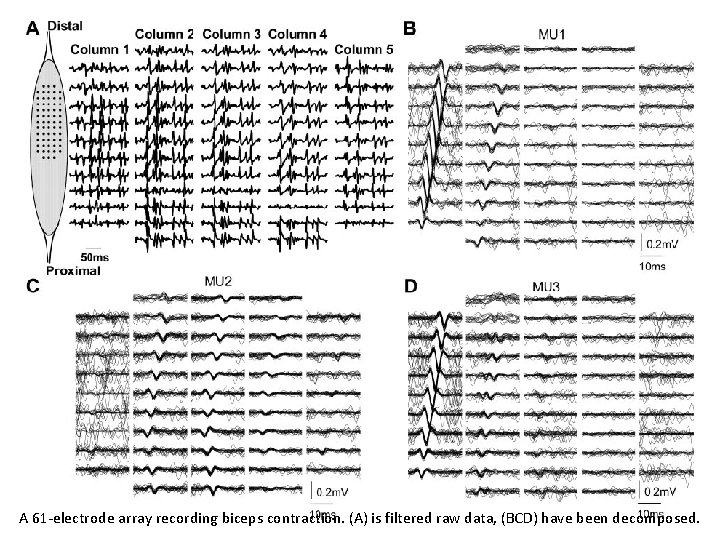 A 61 -electrode array recording biceps contraction. (A) is filtered raw data, (BCD) have