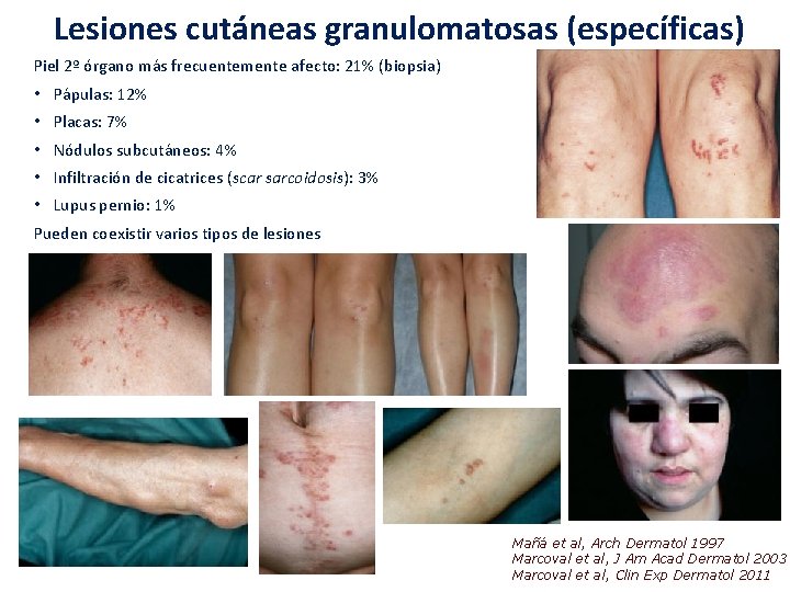 Lesiones cutáneas granulomatosas (específicas) Piel 2º órgano más frecuentemente afecto: 21% (biopsia) • Pápulas: