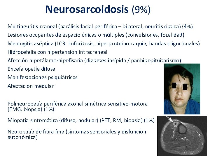 Neurosarcoidosis (9%) Multineuritis craneal (parálisis facial periférica – bilateral, neuritis óptica) (4%) Lesiones ocupantes