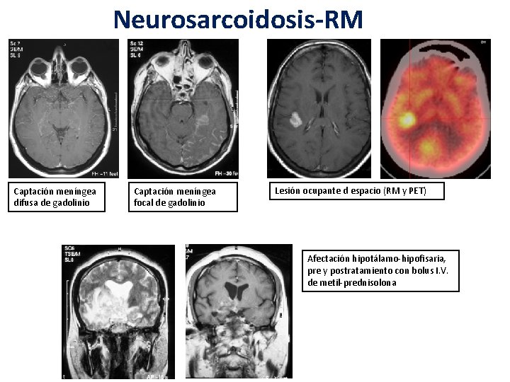 Neurosarcoidosis-RM Captación meníngea difusa de gadolinio Captación meníngea focal de gadolinio Lesión ocupante d Neurosarcoidosis-RM Captación meníngea difusa de gadolinio Captación meníngea focal de gadolinio Lesión ocupante d