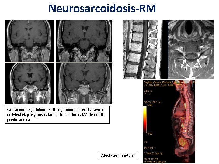 Neurosarcoidosis-RM Captación de gadolinio en N trigémino bilateral y cavum de Meckel, pre y