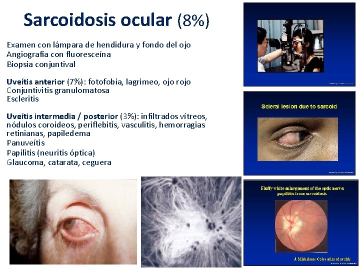 Sarcoidosis ocular (8%) Examen con lámpara de hendidura y fondo del ojo Angiografía con