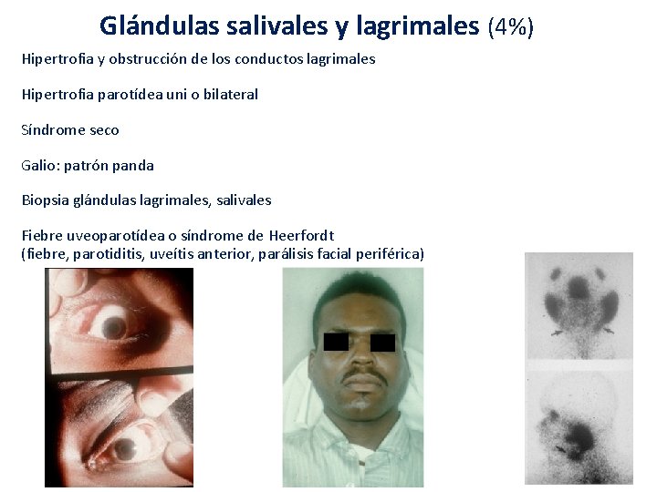 Glándulas salivales y lagrimales (4%) Hipertrofia y obstrucción de los conductos lagrimales Hipertrofia parotídea