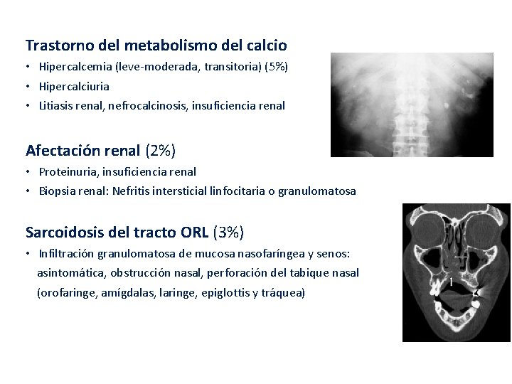 Trastorno del metabolismo del calcio • Hipercalcemia (leve-moderada, transitoria) (5%) • Hipercalciuria • Litiasis