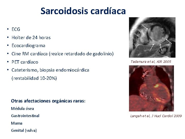 Sarcoidosis cardíaca • ECG • Holter de 24 horas • Ecocardiograma • Cine RM