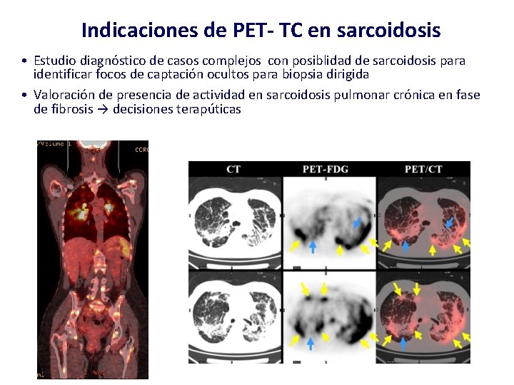 Indicaciones de PET- TC en sarcoidosis • Estudio diagnóstico de casos complejos con posiblidad