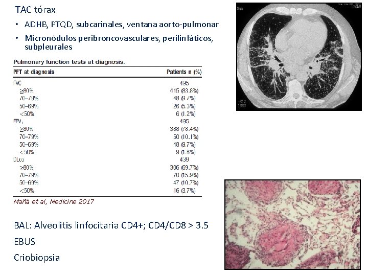 TAC tórax • ADHB, PTQD, subcarinales, ventana aorto-pulmonar • Micronódulos peribroncovasculares, perilinfáticos, subpleurales Mañá