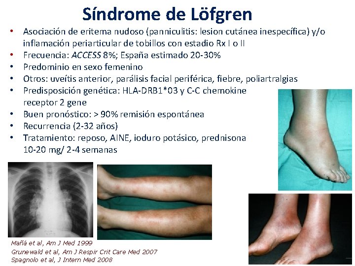 Síndrome de Löfgren • Asociación de eritema nudoso (panniculitis: lesion cutánea inespecífica) y/o inflamación