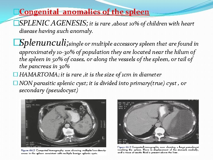 �Congenital anomalies of the spleen �SPLENIC AGENESIS; it is rare , about 10% of