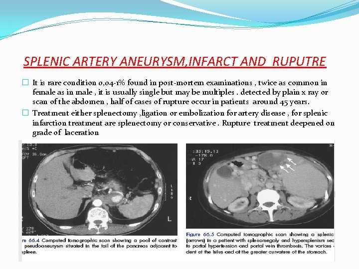 SPLENIC ARTERY ANEURYSM, INFARCT AND RUPUTRE � It is rare condition 0, 04 -1%