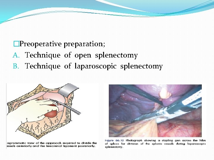 �Preoperative preparation; A. Technique of open splenectomy B. Technique of laparoscopic splenectomy 