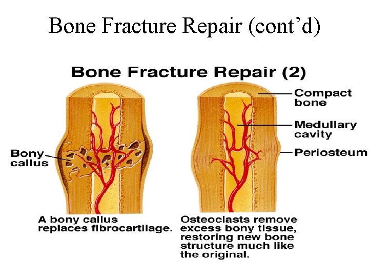 Bone Fracture Repair (cont’d) 
