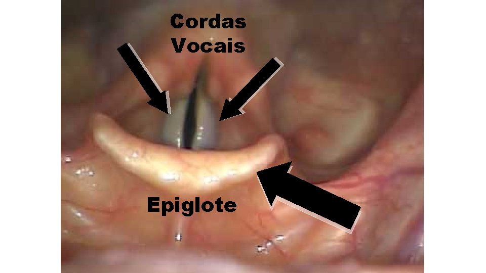 Cordas Vocais Epiglote 