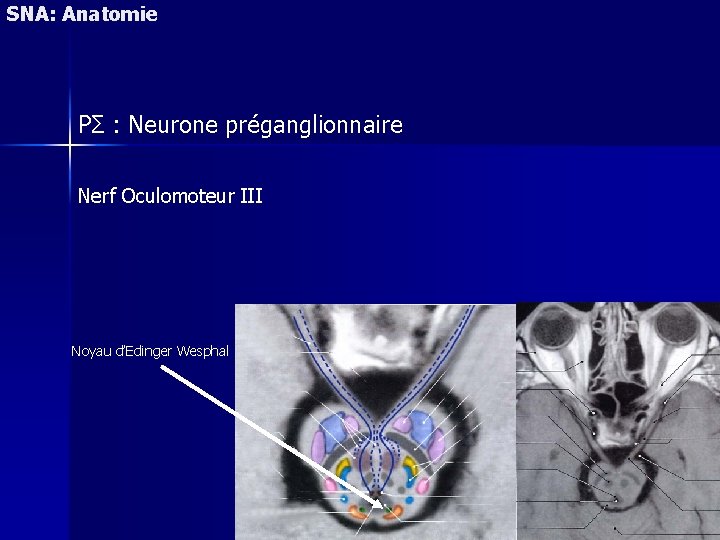 SNA: Anatomie PΣ : Neurone préganglionnaire Nerf Oculomoteur III Noyau d’Edinger Wesphal 