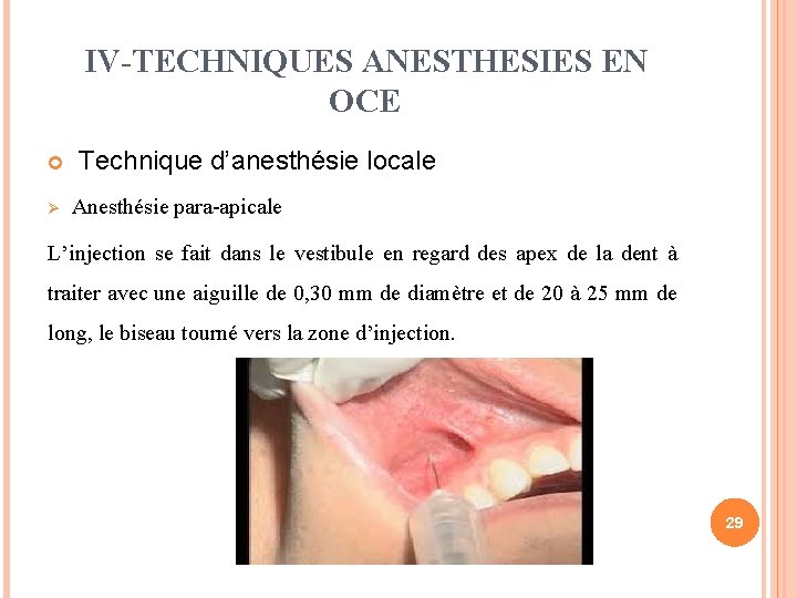 IV-TECHNIQUES ANESTHESIES EN OCE Technique d’anesthésie locale Ø Anesthésie para-apicale L’injection se fait dans