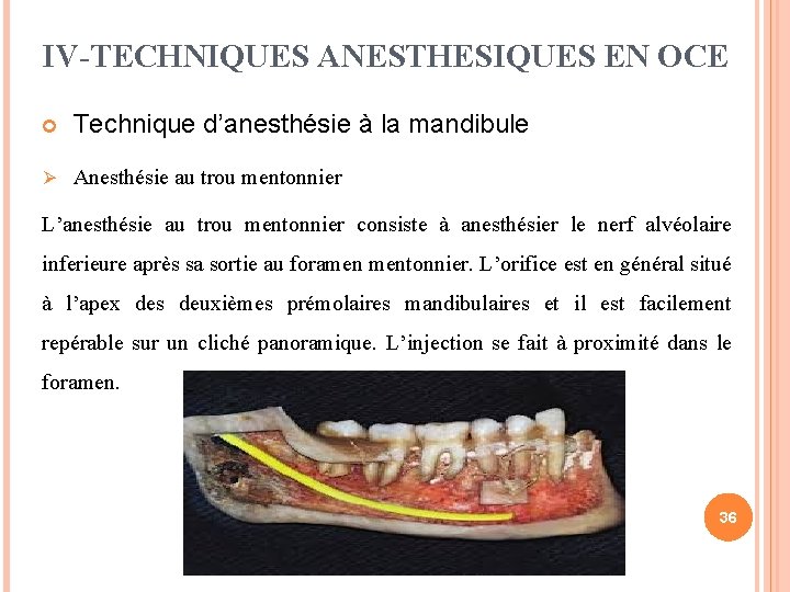 IV-TECHNIQUES ANESTHESIQUES EN OCE Technique d’anesthésie à la mandibule Ø Anesthésie au trou mentonnier