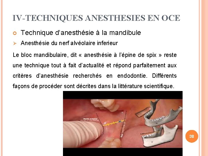 IV-TECHNIQUES ANESTHESIES EN OCE Ø Technique d’anesthésie à la mandibule Anesthésie du nerf alvéolaire