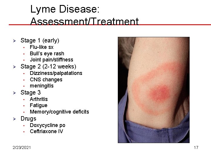 Lyme Disease: Assessment/Treatment Ø Stage 1 (early) • • • Ø Stage 2 (2 Lyme Disease: Assessment/Treatment Ø Stage 1 (early) • • • Ø Stage 2 (2