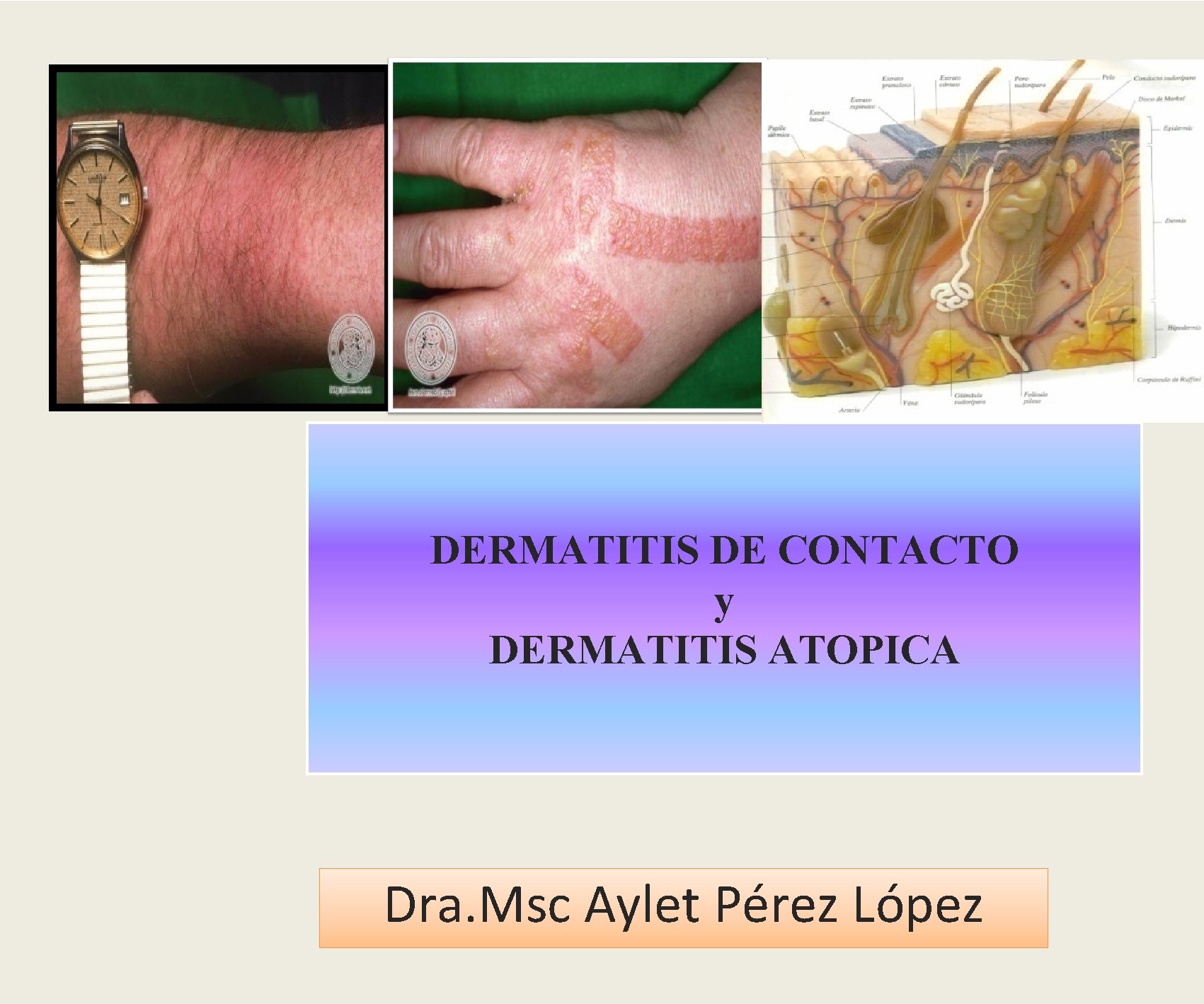 DERMATITIS DE CONTACTO y DERMATITIS ATOPICA Dra. Msc Aylet Pérez López 