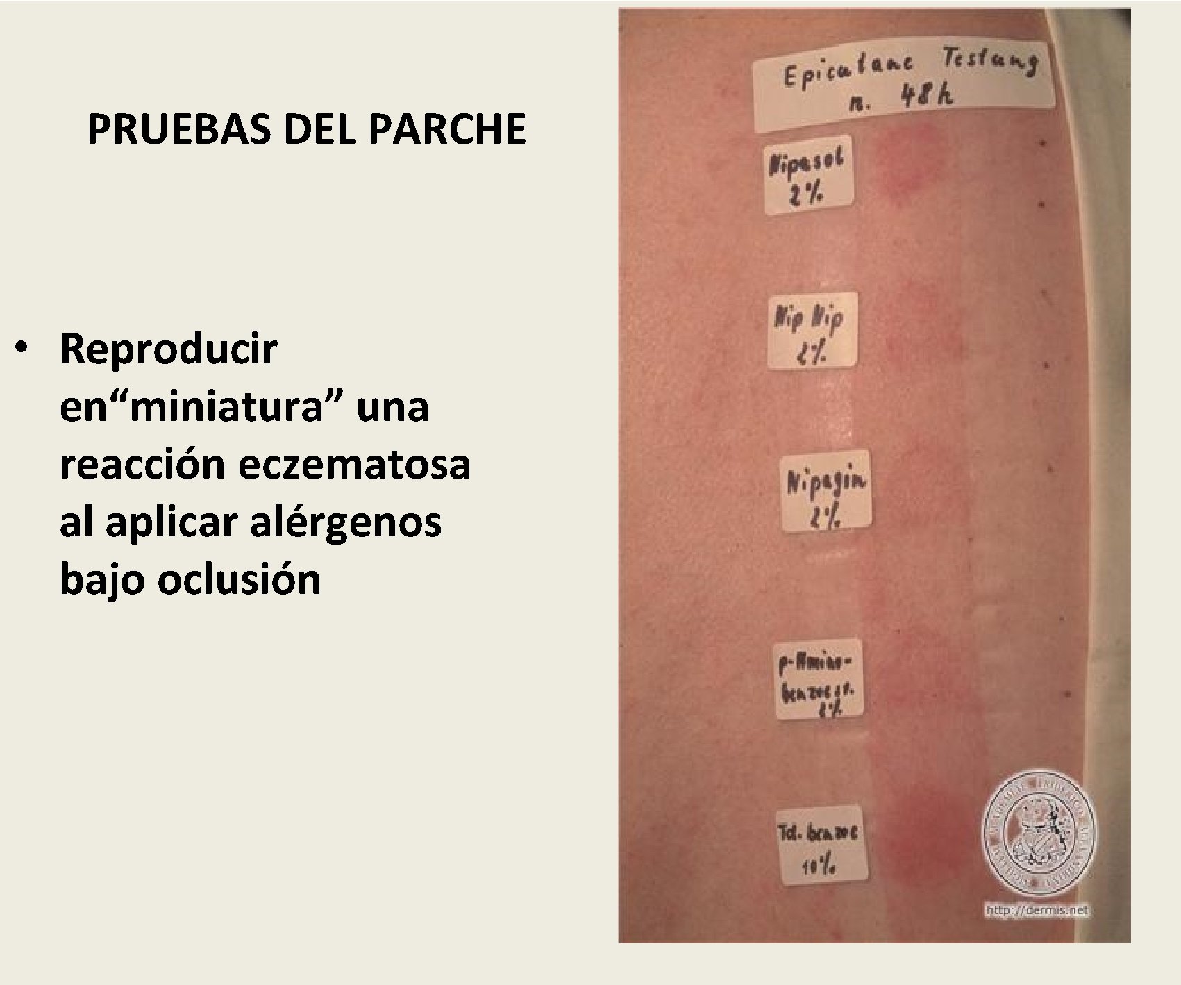 PRUEBAS DEL PARCHE • Reproducir en“miniatura” una reacción eczematosa al aplicar alérgenos bajo oclusión