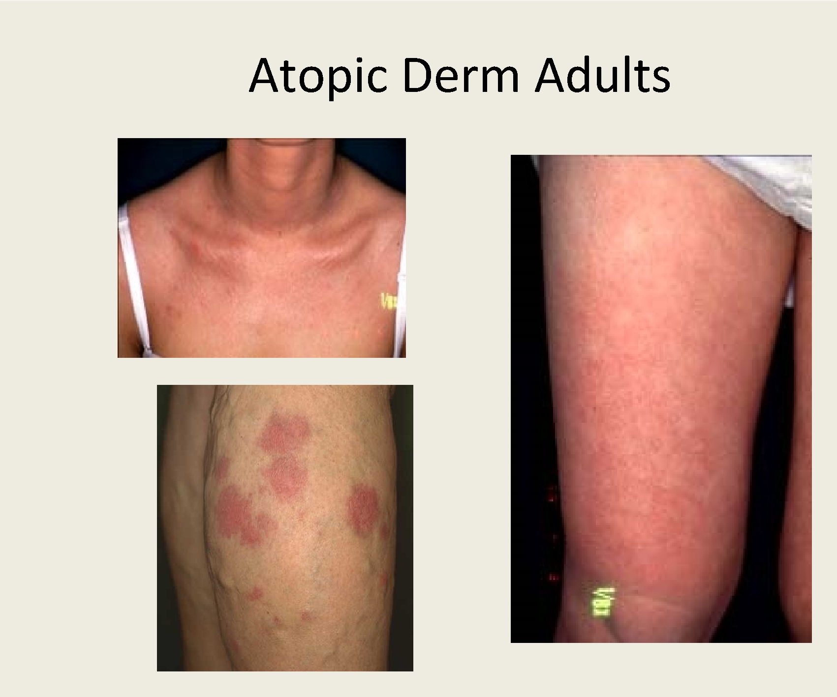 Atopic Derm Adults 