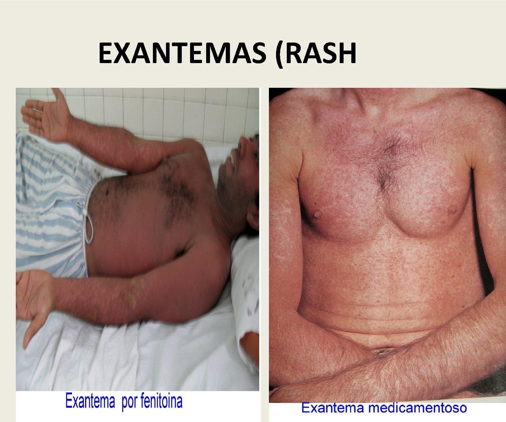 EXANTEMAS (RASH 