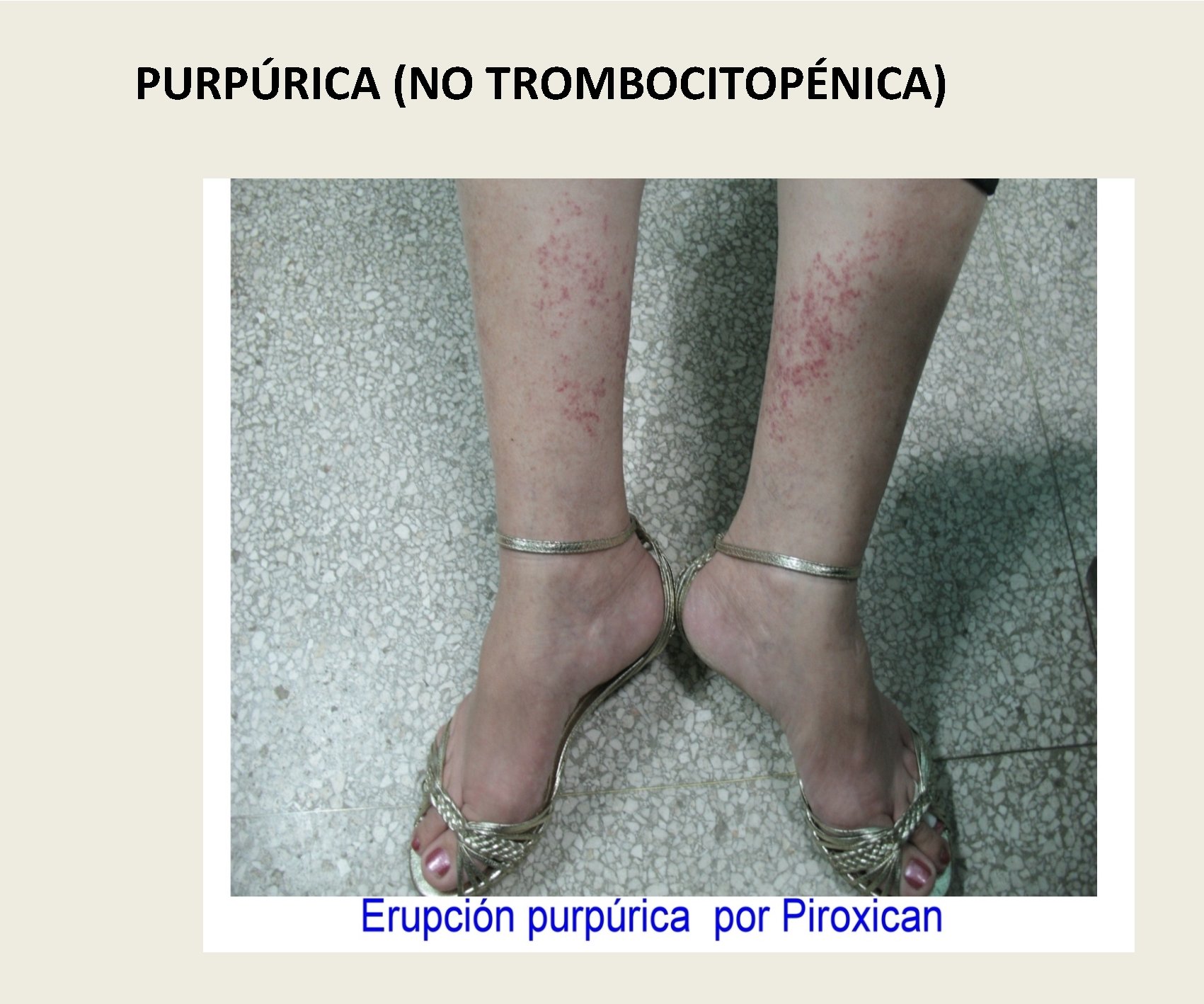 PURPÚRICA (NO TROMBOCITOPÉNICA) 