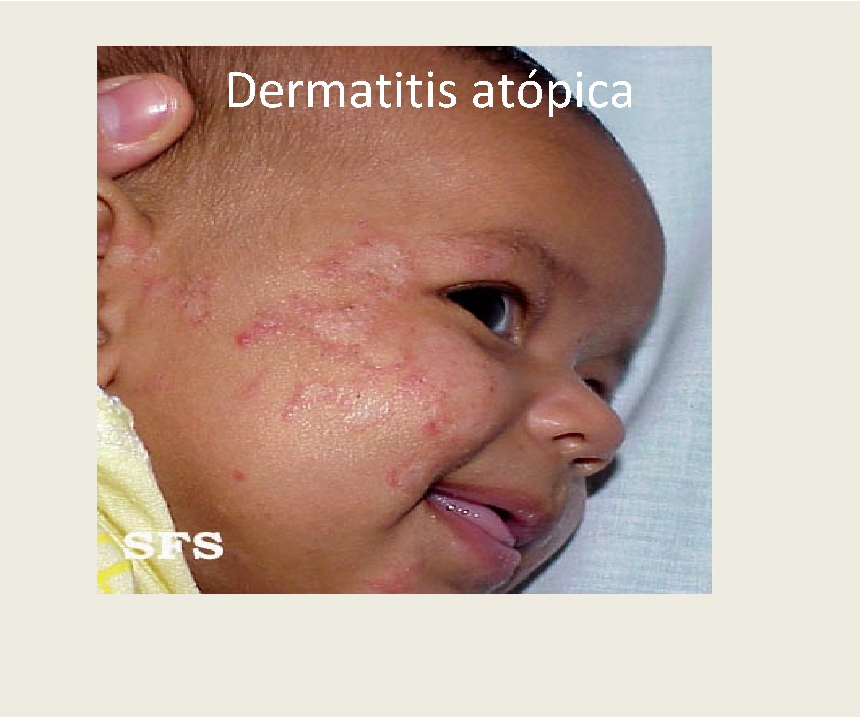 Dermatitis atópica 