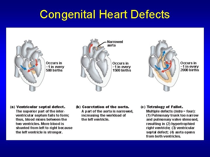 Congenital Heart Defects Narrowed aorta Occurs in ~1 in every 500 births Occurs in Congenital Heart Defects Narrowed aorta Occurs in ~1 in every 500 births Occurs in