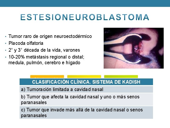  • Tumor raro de origen neuroectodérmico • Placoda olfatoria • 2° y 3°