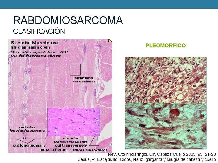 RABDOMIOSARCOMA CLASIFICACIÓN Clasificación de Horri y Enterline (1958) Pleomorfo Embrionario • Botrioide Alveolar PLEOMORFICO