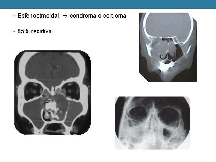  • Esfenoetmoidal condroma o cordoma • 85% recidiva 