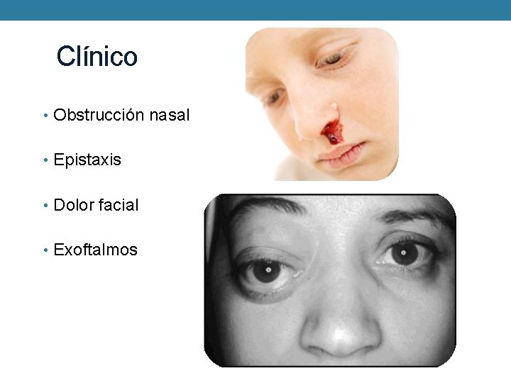 Clínico • Obstrucción nasal • Epistaxis • Dolor facial • Exoftalmos 