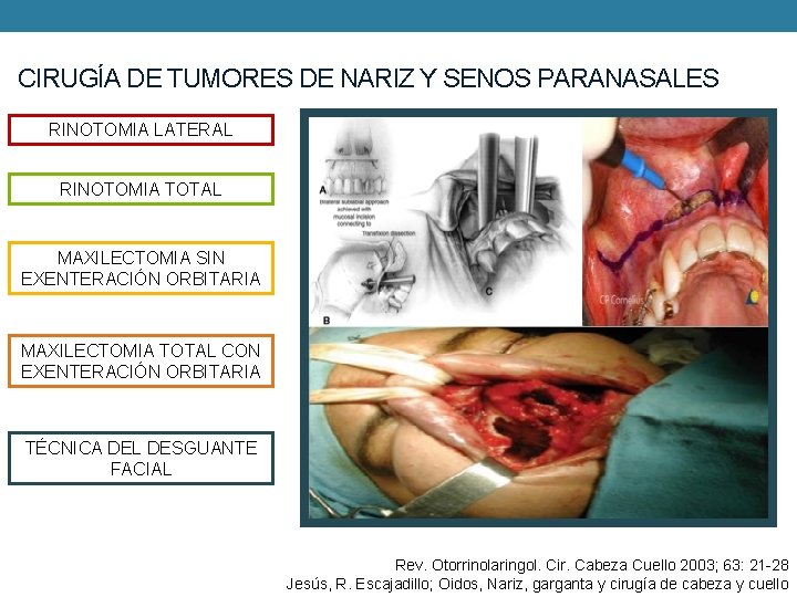 CIRUGÍA DE TUMORES DE NARIZ Y SENOS PARANASALES RINOTOMIA LATERAL RINOTOMIA TOTAL MAXILECTOMIA SIN