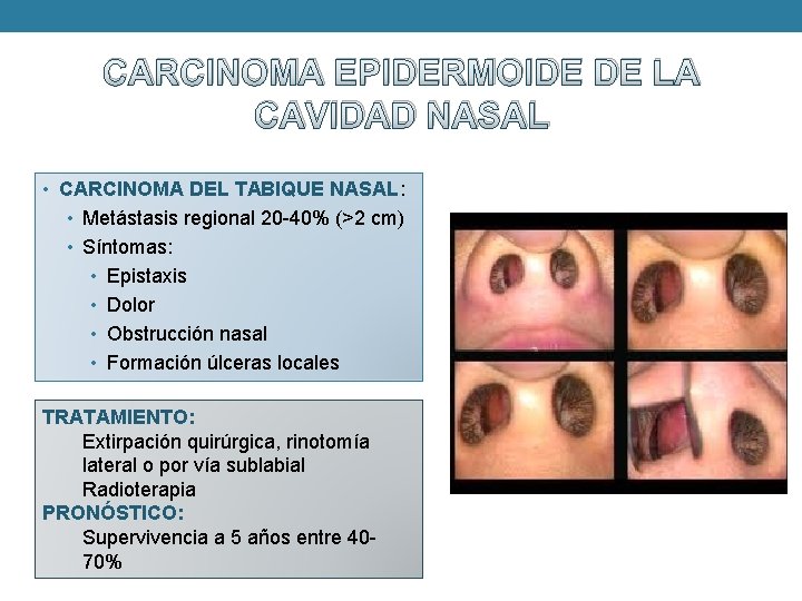 CARCINOMA EPIDERMOIDE DE LA CAVIDAD NASAL • CARCINOMA DEL TABIQUE NASAL: • Metástasis regional