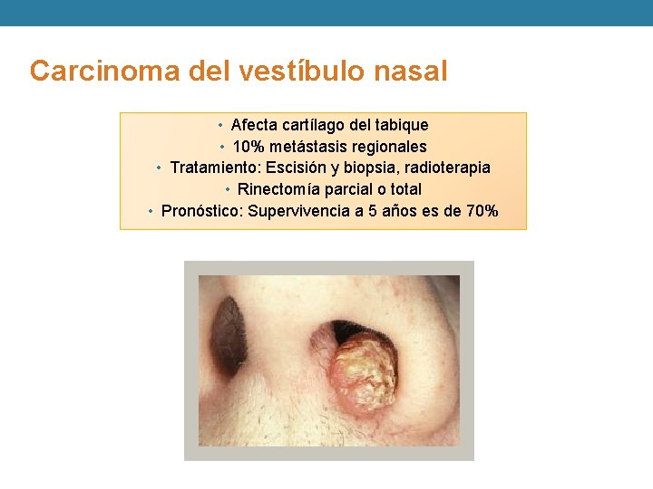 Carcinoma del vestíbulo nasal • Afecta cartílago del tabique • 10% metástasis regionales •