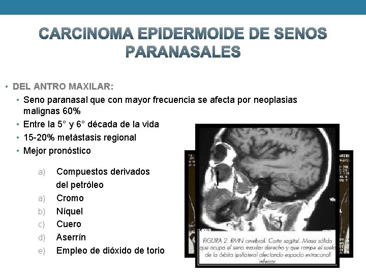 CARCINOMA EPIDERMOIDE DE SENOS PARANASALES • DEL ANTRO MAXILAR: • Seno paranasal que con