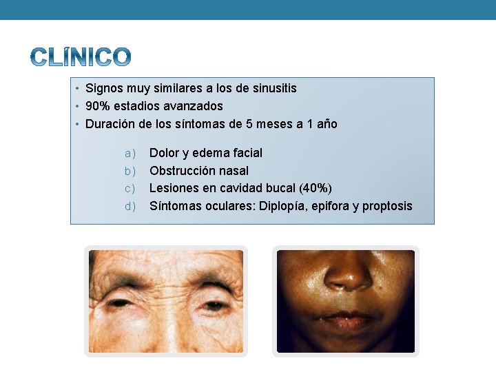  • Signos muy similares a los de sinusitis • 90% estadios avanzados •