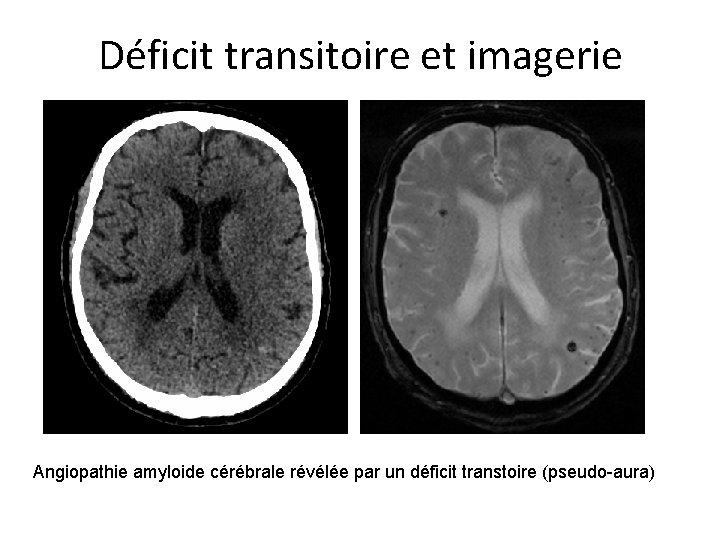 Déficit transitoire et imagerie Angiopathie amyloide cérébrale révélée par un déficit transtoire (pseudo-aura) 